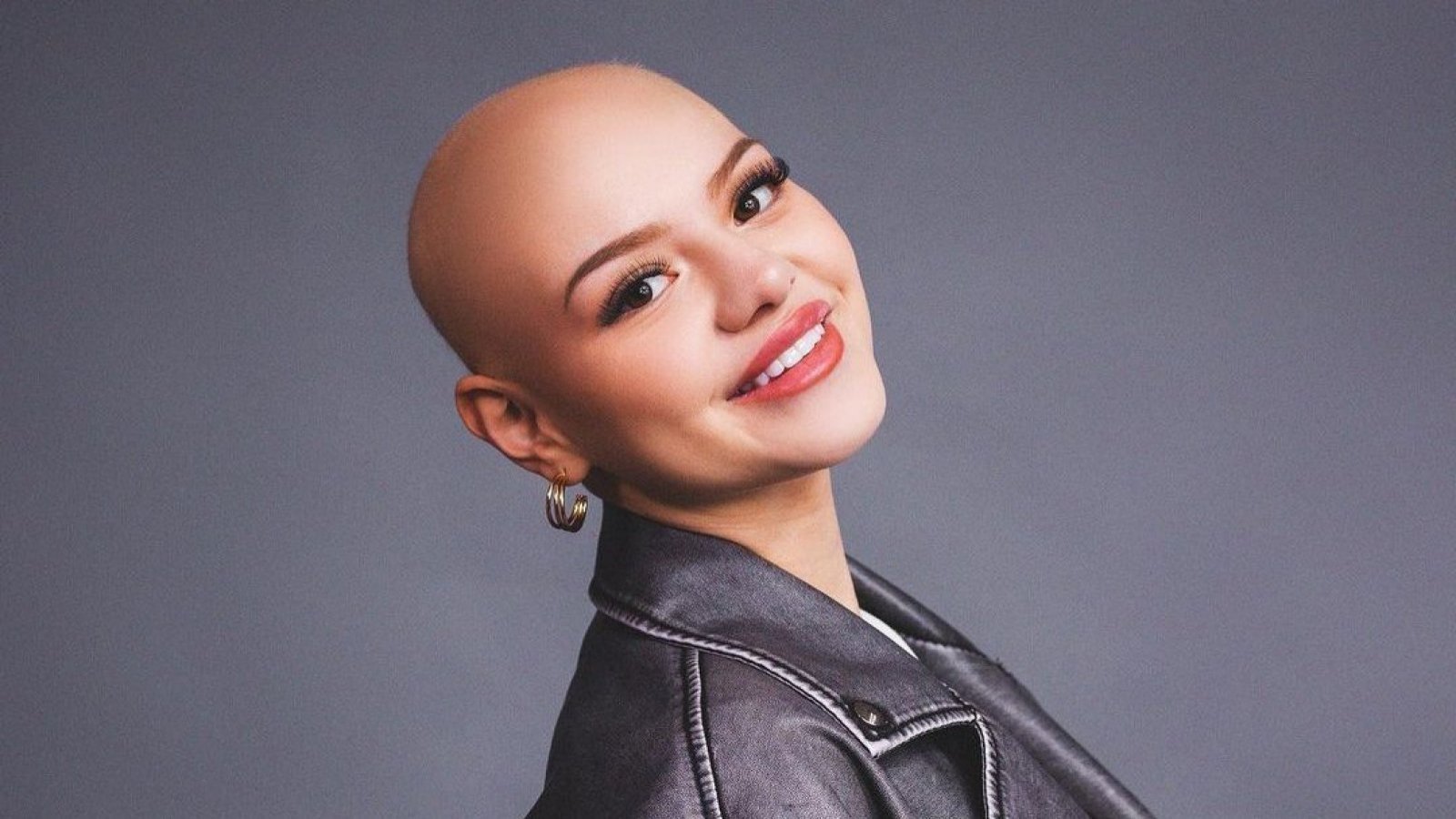 Isidora Carvallo. Alopecia.